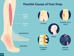 The hamstring muscles are flexors, moving the upper leg (femur). Physical Therapy Exercises For Drop Foot