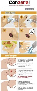 Sometimes they might suggest that kids see a dermatologist (skin doctor), but most kids won't need. Amazon Com Molluscum Treatment Kids Adults By Conzerol Health Personal Care