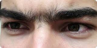 This is called edema, and it causes a small bump on the surface of the skin, much like a mosquito bite. Electrolysis Permanent Body Hair Removal For Men Peach Clinics