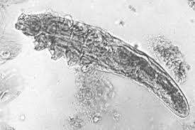 Image result for demodex rosacea