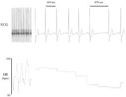 heart rate variability wikipedia