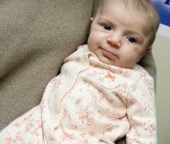 Screening detects heart defect