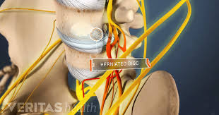 They should sleep in the position that is most comfortable for them. 3 Telltale Signs You Have A Slipped Or Bulging Disc