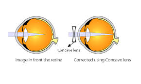 Image result for Refractive Error