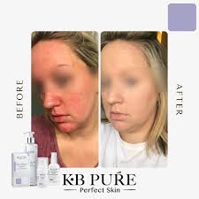 Here's a comprehensive review from Dr. Cheryl Hodge of Clinique Modica, who  has been using KB Pure products for her patients for over 2 years! 🌟 Thank  you for your trust! @cliniquemodica -