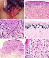 Последние твиты от large labia (@labialarge). Vulvar Cancer A Review For Dermatologists Springerlink