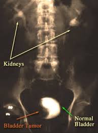 However, if a cat shows symptoms of a major uti without resolution after treatment, it would be important to do additional tests (such as an ultrasound) to rule out cancer. Bladder Cancer Screening And Diagnosis Johns Hopkins Medicine