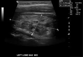 The Term Goiter Is Used When Hyperplasia Leads To Overall Increase In The Size Of The Thyroid Gland Multinodula Thyroid Ultrasound Ultrasound Thyroid Problems