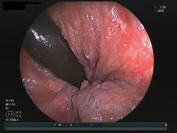 Hämorrhoiden gehören zur menschlichen anatomie. Enddarmerkrankungen Hamorrhoiden