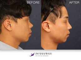 How To Prevent Warping Of Rib Cartilage Used For Nasal Bridge Augmentation Jw Plastic Surgery