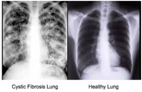 Robert levy md, medical director lung transplant program, bc transplant society, vancouver delane peters, cf. Cystic Fibrosis And Acupuncture Amaluna Wellness
