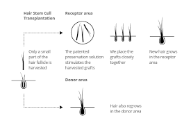 Hair Stem Cell Transplantation Hsi Method Hair Science Institute
