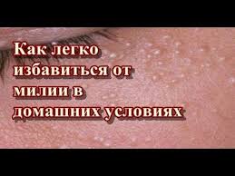 как убрать прыщи на лице за ночь в домашних условиях Miliumy Ili Miliya Ili Prosyanka Eto Syp Kotoruyu Mozhno Prinyat Za Ugri Ili Pryshi Eto Nebolshie Belye Ili Zheltye Kisty Kotorye Maski Dlya Lica Lico Zdorove