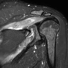 Parsonage Turner Syndrome Radiology Case Radiopaedia Org