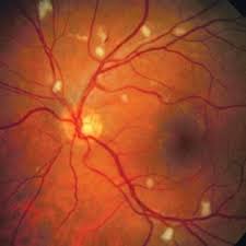 Image result for HIV Retinitis