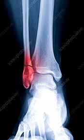 Image result for Ankle XRay