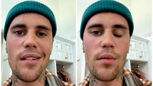 Justin Bieber's face is partially paralyzed