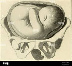 Image result for Shoulder Presentation