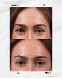 Squamous Cell Carcinoma is a common form of skin cancer. ✔️ Education ✔️  Prevention ✔️ Detection Skin cancer is largely preventable✨ Schedule YOUR  Full-Body Skin Exam 🔗 in Bio #becauseresultsmatter  #skincancerawarenessmonth #squamouscellcarcinoma #