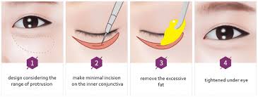 Laser Treatment For Dark Circles Seoul Guide Medical