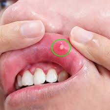 Image result for Puchýře na jazyku