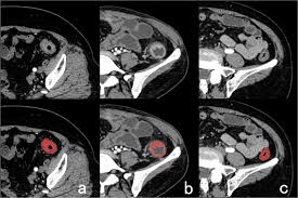 Who should consider genetic counseling and testing and how is it conducted? The Feasibility Of Differentiating Colorectal Cancer From Normal And Inflammatory Thickening Colon Wall Using Ct Texture Analysis Scientific Reports