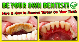 Whiten your teeth with snow® & start smiling again. How To Remove Tartar From Teeth Yourself Reddit Teethwalls