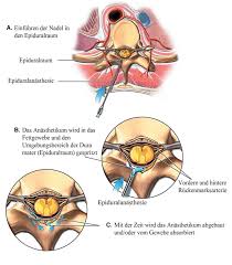 Der gestorbene embryo und die plazenta müssen aus der gebärmutter herausgeholt werden, um gefährliche komplikationen zu verhindern. Ausschabung Fehlgeburt Periode Nach Schwanger Ablauf Gebarmutter