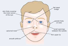 Alcohol And Human Health 1 5 Fetal Alcohol Syndrome Openlearn Open University Sdk125 2