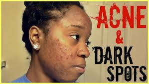 Acne To Clear Skin Journey ♥