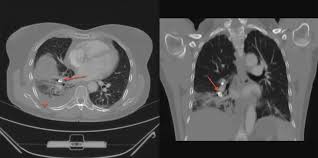 Image result for Broncholithiasis