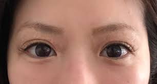 『マドンナリフト』と呼びます。 （マドンナリフトはdeka社の商標登録です） smartxide dotの皮膚の収縮作用を利用して、 目の周囲のたるみと眼瞼下垂を改善し、 コラーゲンをふやすことでハリを蘇らせます。 こちらがマドンナリフト前後のお写真です。 ç›®å…ƒã®ãŸã‚‹ã¿ã‚·ãƒ¯ã«ã¯ãƒžãƒ‰ãƒ³ãƒŠãƒªãƒ•ãƒˆ çµŒéŽå†™çœŸä»˜ã æ±äº¬ å¤§é˜ªã®ç¾Žå®¹çš®è†šç§'ãªã‚‰flalu ãƒ•ãƒ©ãƒ«ã‚¯ãƒªãƒ‹ãƒƒã‚¯