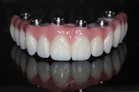 Image result for dental implant