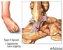 The severity of the injury and associated symptoms increases from grade1 to grade 3. Inversion Ankle Sprains Gymnastics Injuries