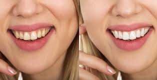 Lower the opacity slider to reduce the effect. 5 Steps For Whiten Teeth In Photoshop Psd Stack