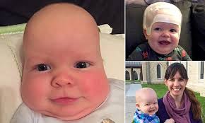 Matthew Boler's mother shares photo of baby's odd-shaped head to warn of  serious condition