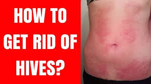 Sunlight, heat, pressure, virus, inflammation and even mix it well with some plan water and spread it over your hives. 50 How To Get Rid Of Hives Fast Ideas Hives How To Get Rid Urticaria
