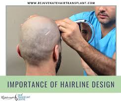 This occurs in men with androgenetic alopecia (aga) and can lead to. The Importance Of Hairline Design In Hair Transplant