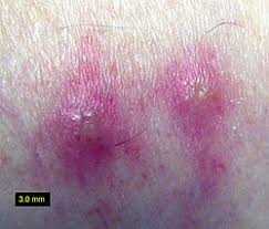 Image result for Trombicula autumnalis bites