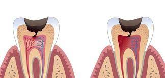 Tooth decay, also known as dental caries or cavities, is the breakdown of teeth due to acids made by bacteria. Dental Caries Market By Treatment Type End User And Region Industry Size Growth Technology And Trend Analysis Forecast To 2026 Medgadget