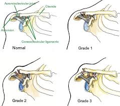 How to fix a separated shoulder. Separated Shoulder And Ac Joint Injury Explained