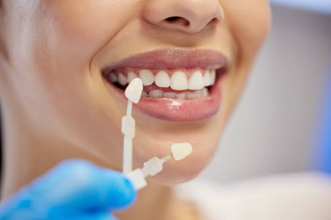 Veneers Denver CO: Expert Care Tips for Long-Lasting Results