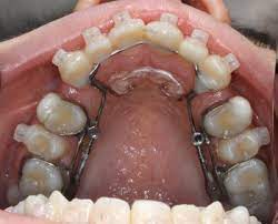 Jaw Expansion Without Surgery Robina Town Dental