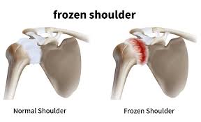 Image result for Frozen Shoulder
