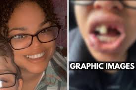 Reading mum loses teeth in in freak accident