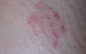 Se administrează tratament simptomatic la recomandarea medicului. Porumbel Cerc De Rulment RÄƒmÄƒÈ™iÈ›e Pete Rosii Pe Picioare Si Mancarimi Apitotal Ro