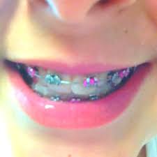 Black And Pink Braces Braces 3 Braces Colors Braces Tips Cute Braces