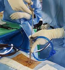 Check spelling or type a new query. Endoscopic Spine Surgery What It Is And What It Isn T