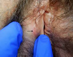 Image result for genital herpes