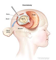 If you are diagnosed with a brain tumor, make sure your provider helps you understand where it is located. Spinal Cord Tumor Pediatric Cancer Treatment Dana Farber Cancer Institute Boston Ma